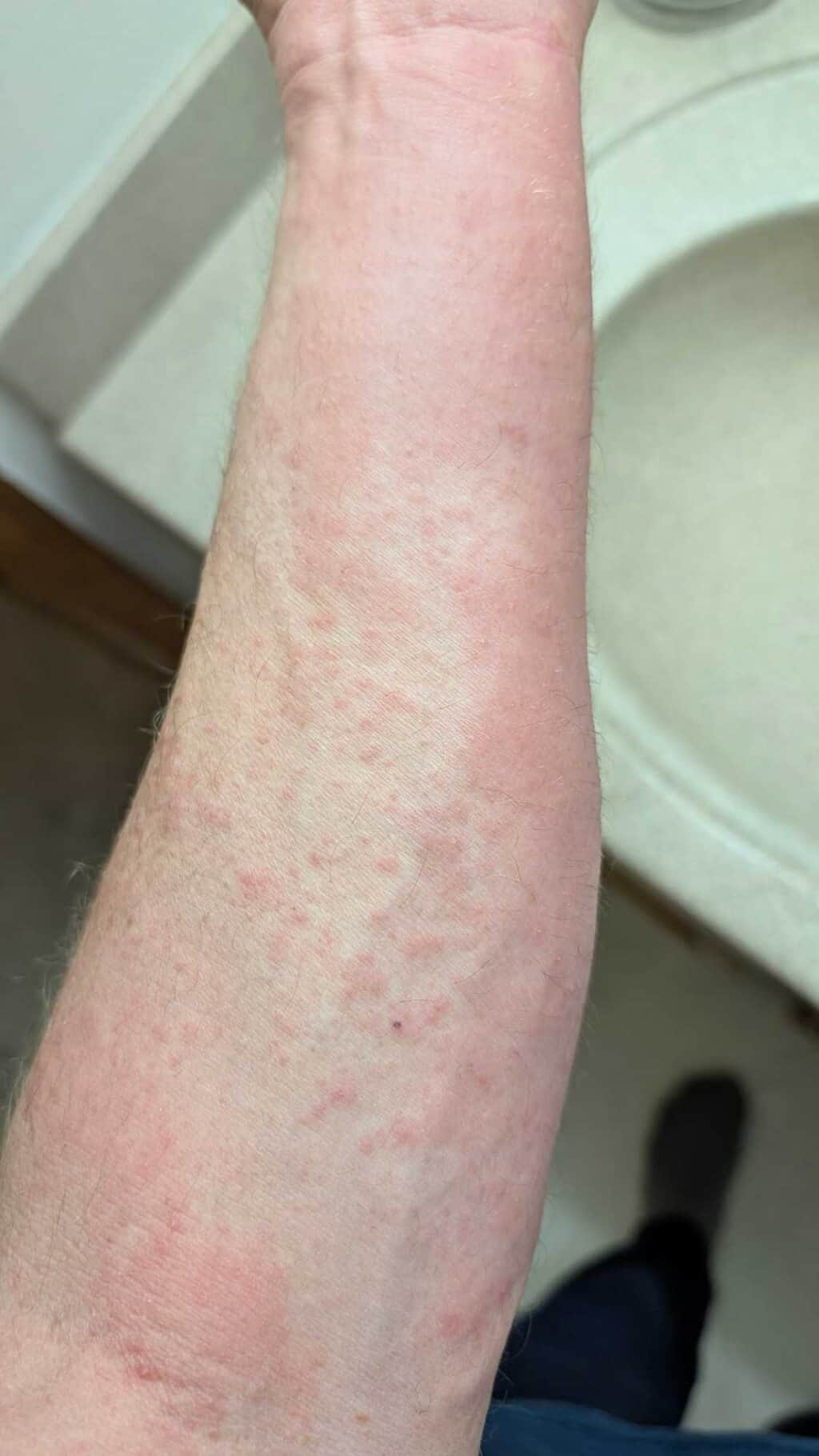 Major epoxy reaction in my body tonight